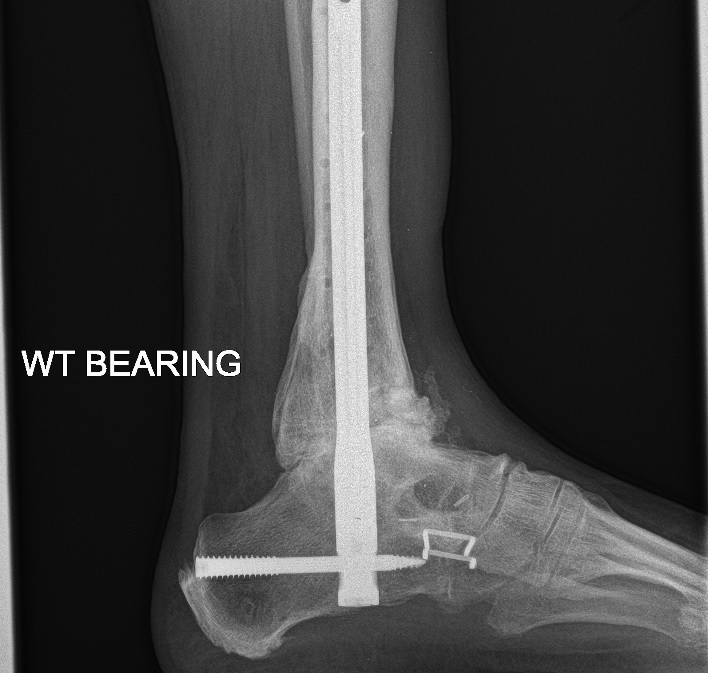 Example of Ankle Arthrodesis after severe Trauma caused Ankle Arthritis