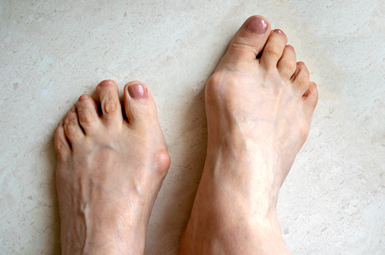 Foot Deformities